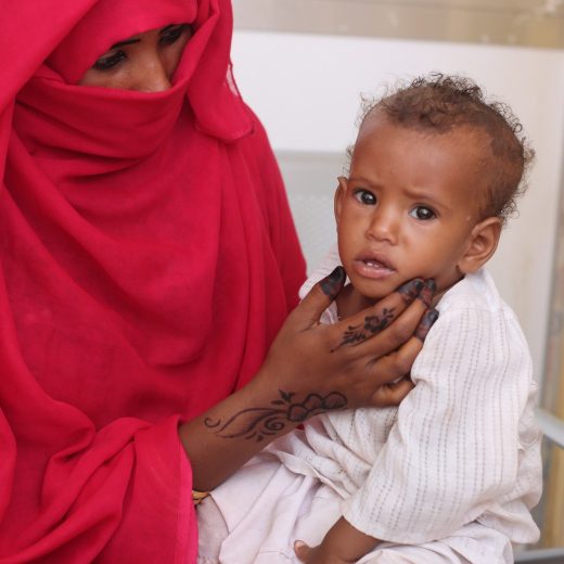 Ein mangeernährtes Kind in einem Camp im Sudan